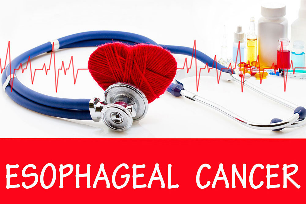 Esophageal cancer – Signs, causes, and management